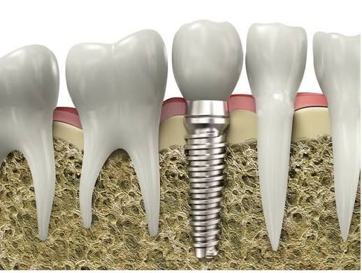 Dental Implants